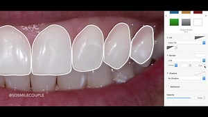 Digital Smile Design