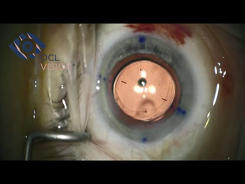 RayOne Toric (2022) implantation by Mr Allon Barsam, OCL Vision