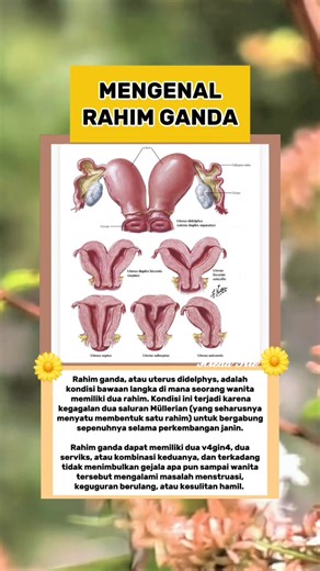 Rahim ganda, atau uterus didelphys, adalah kondisi bawaan langka di mana seorang wanita memiliki dua rahim. #ceritakehidupan #fypreels #parenting #pregnancy #rahimganda | Hieda Trie