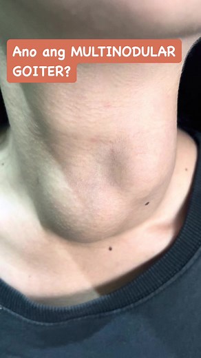 Ano ang multinodular goiter? #goiter #thyroid #GoiterAwareness #thyroidcancer #thyroidhealth | Irma Antonio-Pilar MD/ Diabetes and Thyroid Specialist