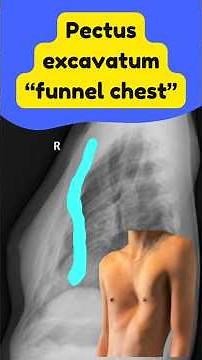 Funnel Chest #shorts
