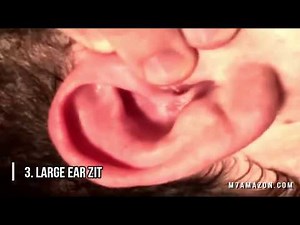 Top Five Ear Blackheads of All Time! Dilated Pores of Winer