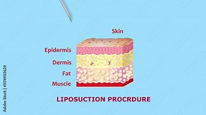 Mechanism of liposuction. Suction-assisted liposuction. Hollow tube or cannula, which is inserted through a small incision in the skin in order to fat suctioned out of the body. 3D animation Stock Video