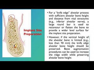 basic implant surgical procedure and osseointegration