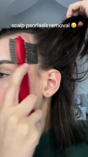 Scalp Psoriasis Removal: Satisfying Treatment Videos | Psoriasispatches