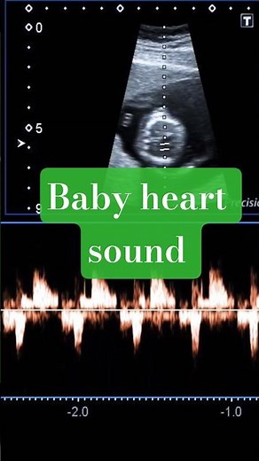 Baby heart sound || #baby #babyheartbeat #fetalheartbeat #mbbs #aiims #anatomy #nursing #nurselife