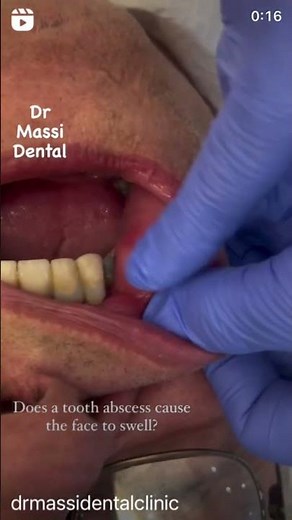 Dental abscess, cheek swelling
