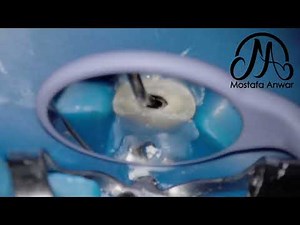 Open Apex Management | BC Putty Apical Plug | Apexification | MAP One System | MTA Application Tools