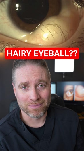 Hair. On. Your. Eyeball.