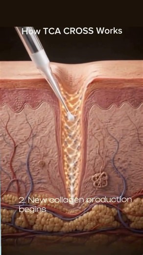 Deep Acne Scars? Watch This 👀 | This Is Why TCA CROSS Works |TCA CROSS Explained In Seconds ✨