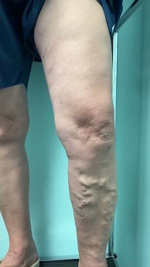 Treatment of LARGE Varicose Veins