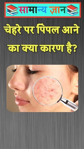 What is the reason for pimples on the face? #gkinhindi #gkquestion
