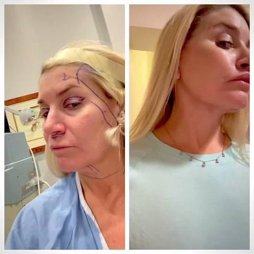 Deep Plane Facelift: Natural and Rejuvenating Facelift Results #deepplanefacelift