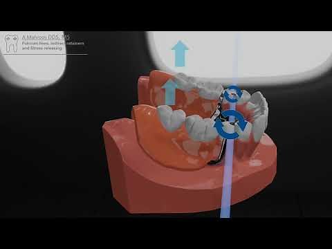 Fulcrum lines, Indirect retainers and Stress breaking clasps in 8 mins
