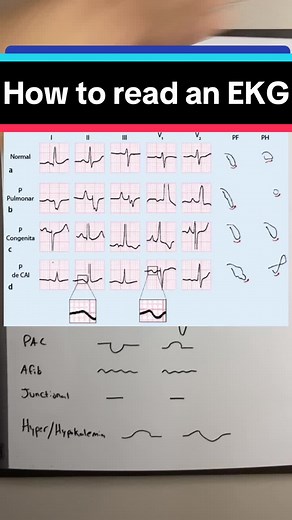 Understanding EKG P Wave Morphology for Heart Assessment