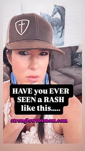 Most people assume rashes are just “allergies” or “eczema.” But in many cases, the root cause can be heavy toxic load and parasites, including nematodes (roundworms). Roundworms can trigger skin reactions when larvae migrate through tissue or interact with the immune system. Here’s where rashes often show up and why 👇 Feet and ankles Common with soil or sand exposure Buttocks and backs of thighs Often linked with Strongyloides exposure Abdomen and waistline Immune response to internal parasites