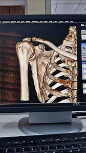 ##ctscan 3DCT Imaging of Shoulder joint in 7 steps.