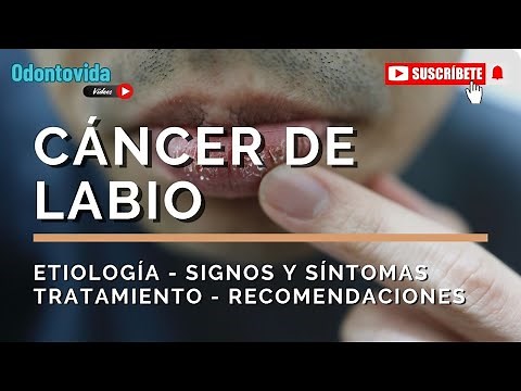 Cáncer de Labio. Todo lo que necesitas saber