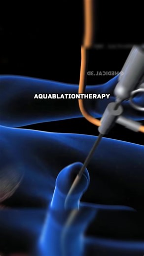 Aquablation Therapy For Enalrged Prostate Treatment! (3D Animation) #enlargedprostate #bph #benignprostatichyperplasia #benignprostatichyperplasiatreatment #prostateenlargement