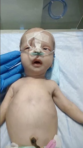 "28 Days Old Baby | Birth Asphyxia HIE-3 | NG Feeding, Suction & NICU Nursing Care"