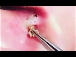 10K views · 78 reactions | Top 5 Blackheads Removing - EP10 -...