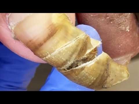 Extremely Long Toenails, Easy To Cut Dirty Nails【Dr. Liu's Pedicur】