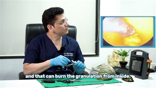 Video Assisted Anal Fistula Treatment (VAAFT)_ Step-by-Step Guide _ Advanced Tre