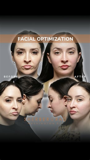 Ariel N. Rad, M.D., Ph.D., F.A.C.S. on Instagram: "FaceOps Part II: Meet Kacy, a beautiful young lady in her mid-30s who sought facial rejuvenation and facial optimization (and a perfect example of the Wall Street Journal article in which I was featured). She started to be bothered by early signs of aging. Fillers stopped giving her the improvements she wanted, and instead started to distort her features, not to mention their temporary effects. She didn’t need or want an overhaul, but instead sh