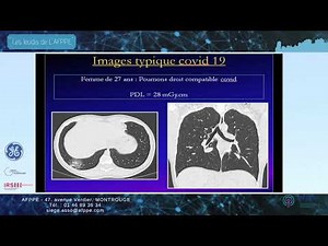 Le scanner pulmonaire du COVID-19