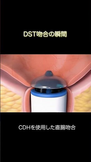DST吻合の瞬間 #手術室看護師 #オペ
