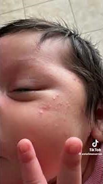 How to get rid of pimples on babies' faces, atopic dermatitis or dermatitis in newborn babies