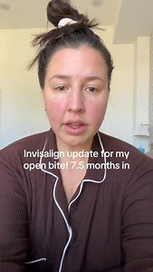 Fixing an open bite with clear aligners is super effective! #invisalign #openbite #braces #orthodontist | Dr. Sable Staller DDS, MS