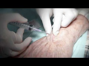 Aspiration of ganglion cyst