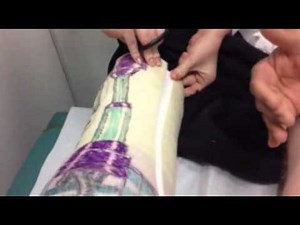Full-leg cast removal