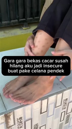 Bekas cacar dan insecure ikutan ilang setelah aku nemuin produk yang satu ini 🥰🔥 #JelajahMerdeka #jamur #koreng #lukabakar #fypシ゚viral #gatal #bekasluka #Minyakkletik #bekascacar #keloid #melepuh #keloidremoval