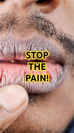 Cracked Lips? Fix This! #health #facts #healthtips