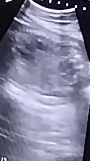 Fetal Spine shown in ultrasound