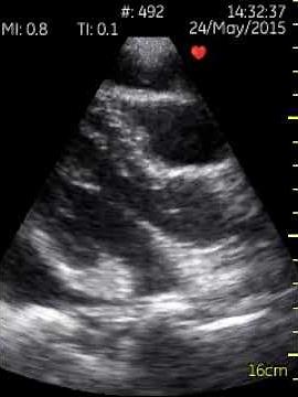 RV collapse during ventricular filling = tamponade sign