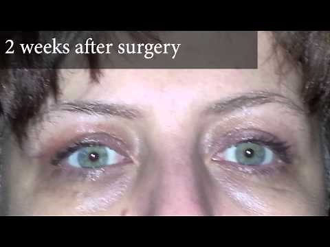 Upper Eyelid Surgery Before & After Photos 2 Week Post Op | 8 West Clinic in Vancouver, BC