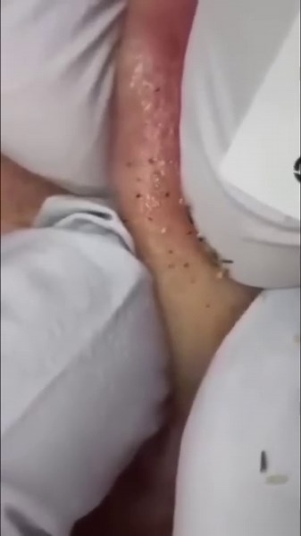 SHOCKING! How to Remove GIANT Blackheads on Your Nose! [sacdepspa ASMR]