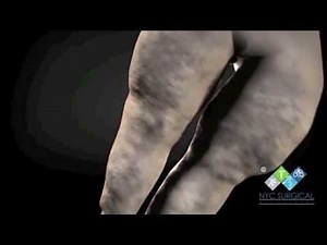 Lipedema Treatment New York, NJ | Animation By NYC Surgical Associates