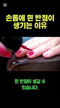 If you have white spots on your nails, check the cause. #Nails #Spots #NutritionalDeficiency #Mal...