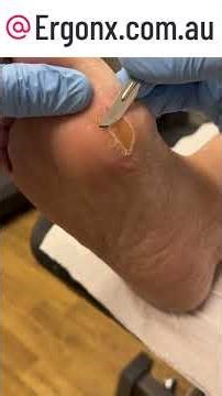 Ultimate Thick Callus Removal: Amazingly Satisfying Transformation #Satisfying #CallusRemoval