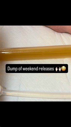 The tube says it all - heavy gas, waste, un digested food, bile flow from the liver. The results here say it all in why colonics are freaking amazing in helping gut issues 💪🏽 Who wouldn’t feel better after these releases? #goldcoastcolonics #gccolonics #colonicsgoldcoast #colonhydrotherapygoldcoast #colonicsgc | Gold Coast Gravity Colonics