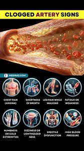 Clogged Artery Signs: 8 Warning Symptoms You Should Never Ignore Clogged arteries happen when fatty deposits (plaque) build up inside your blood vessels, reducing blood flow to vital organs like the heart, brain, and legs. This condition—also called atherosclerosis—often develops silently for years before serious problems appear. Knowing the early signs can literally save your life. Let’s break them down in simple terms. Common Signs of Clogged Arteries 🫀 Chest Pain (Angina) A tight, heavy, or 