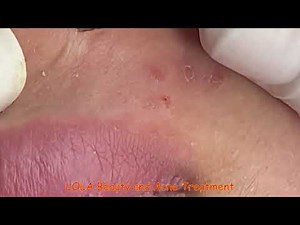 Are You Sure? Acne Removal 62; (Full Screen) Super Big Pops