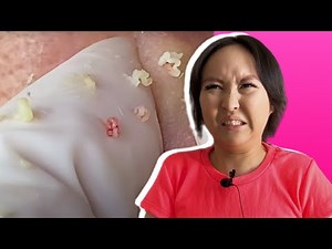 ASMR Relaxing with a reaction to pimple popping #5