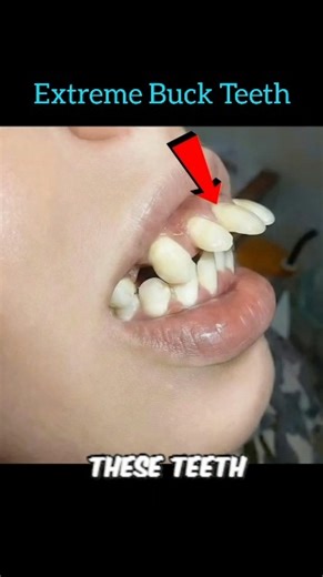 How Braces Fix Extreme Buck Teeth #braces #orthodontist #orthodontics #dental