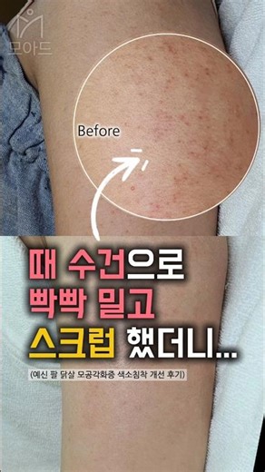메이크업으로도 못 가린 '팔뚝 닭살 모공각화증 색소침착' 개선 후기