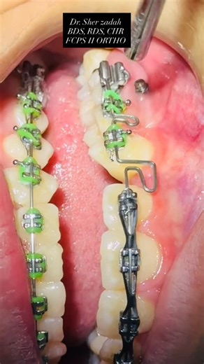 Global Orthodontics on Instagram: "Loop loop activation by omega loop"